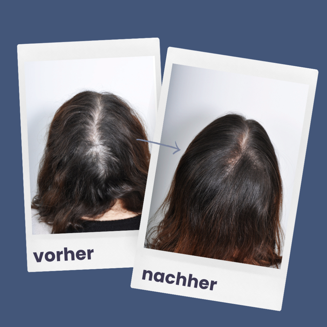 ShinyHair | Growth Kit