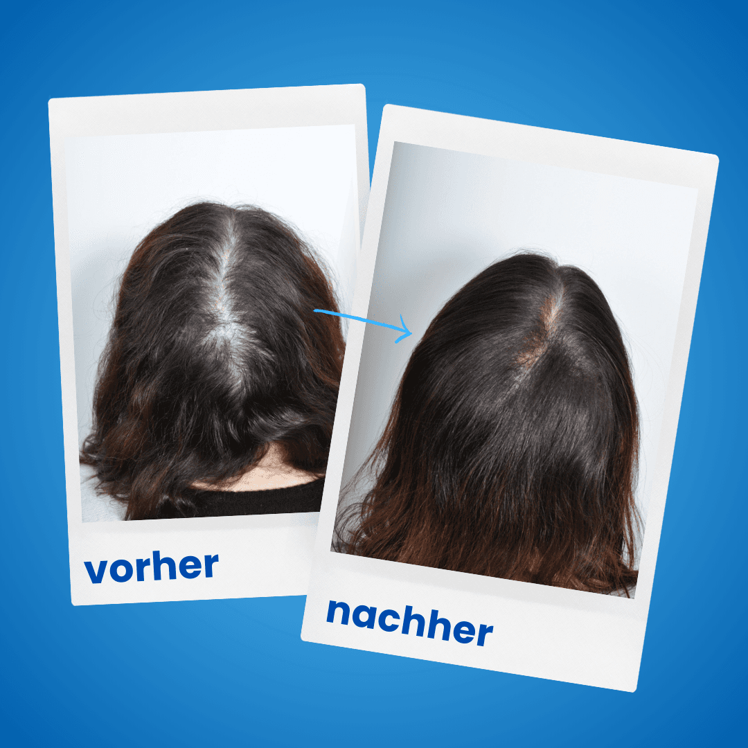 ShinyHair Haarwuchsbooster Sale