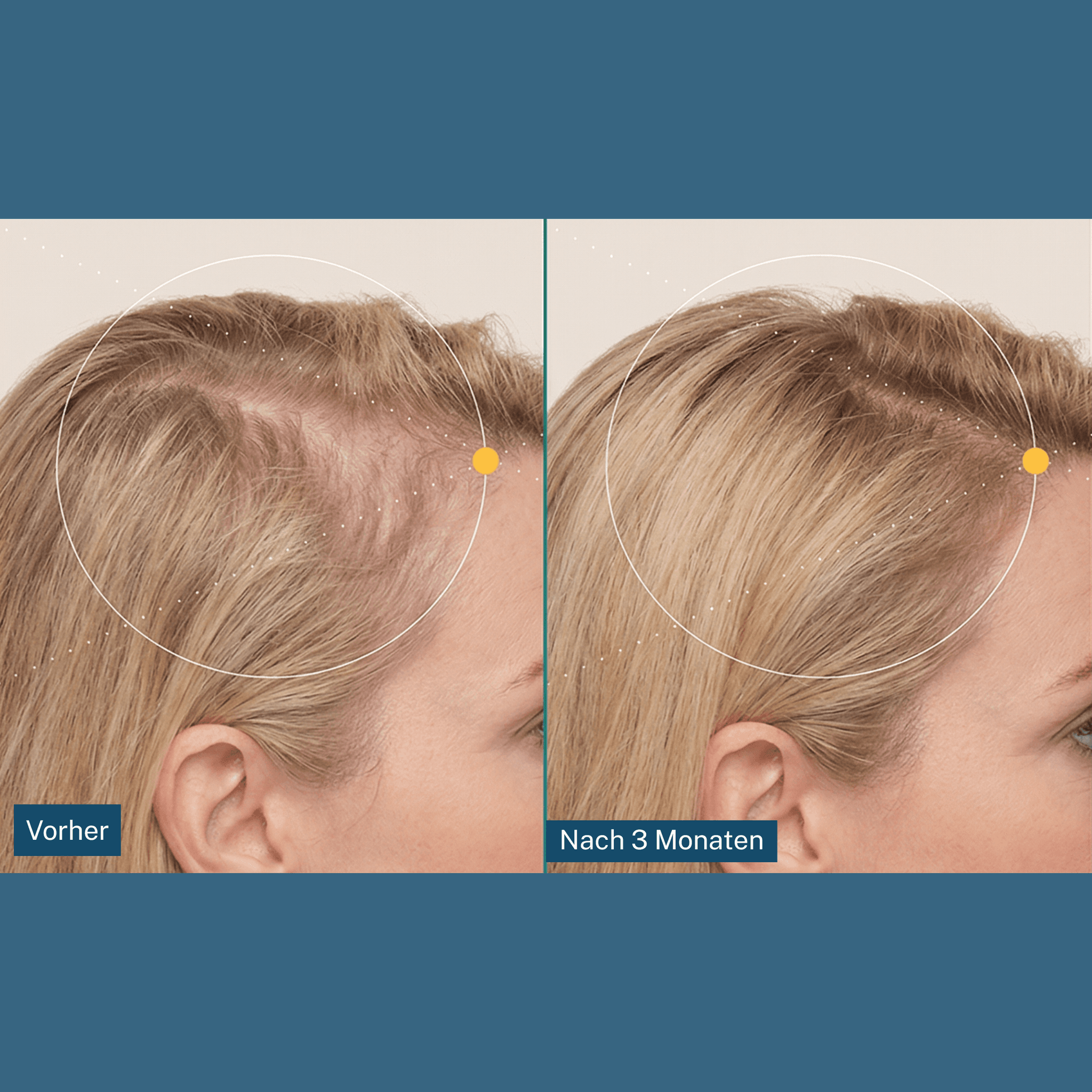 Dermastamp für die Kopfhaut